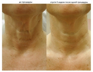 garmoniya-omolozheniya-harmony-xl-pro-ot-alma-lasers-reshenie-shirokogo-spektra-esteticheskikh-problem