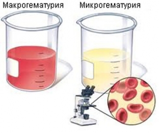gematuriya-o-chem-signaliziruet-poyavlenie-krovi-v-moche