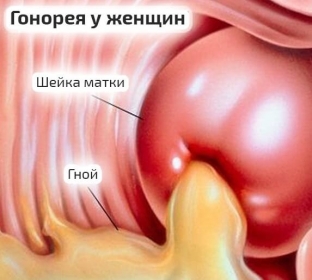gonoreya-u-zhenshchin-osobennosti-techeniya-i-spetsifika-terapii