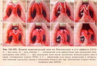 idealnyj-nosik-s-pomoshchyu-nedestruktivnoj-plastiki-konchika-nosa
