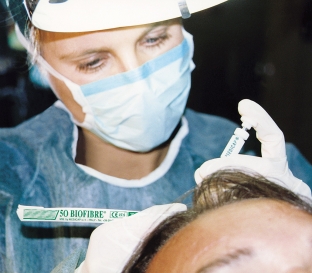 implantatsiya-volos-biofibre-optimalnoe-lekarstvo-ot-oblyseniya
