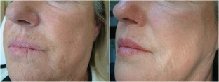 in-ektsionnoe-bioremodelirovanie-kozhi-preparatom-profhilo-tekhnika-5-bep