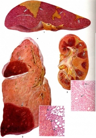 infarkt-pochki-prichiny-i-simptomy-opasnoj-patologii