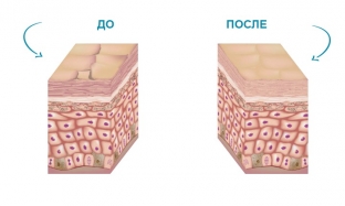 ionoforez-v-kosmetologii-opisanie-protsedury-pokazaniya-i-protivopokazaniya