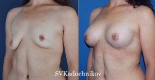izbezhat-oslozhnenij-posle-plastiki-grudi-pomozhet-tshchatelnaya-podgotovka-k-operatsii