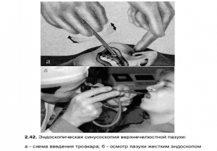 kak-i-zachem-provoditsya-diagnosticheskaya-endoskopiya-nosa