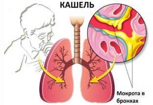kak-izbavitsya-ot-kashlya-taktika-lecheniya