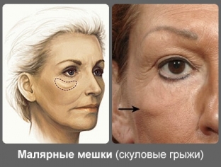 kak-izbavitsya-ot-malyarnykh-meshkov