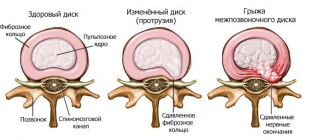 kak-izbavitsya-ot-mezhpozvonochnoj-gryzhi-problema-nomer-odin-dlya-lyudej-stradayushchikh-bolyami-v-spine