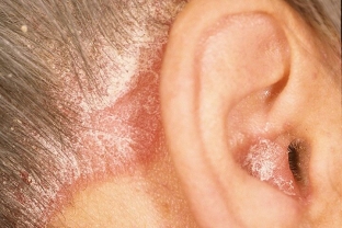 kak-izbavitsya-ot-seborejnogo-dermatita-effektivnye-metody-lecheniya