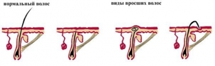 kak-izbavitsya-ot-vrosshikh-volos-posle-depilyatsii-ili-epilyatsii