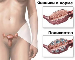 kak-ozhirenie-vliyaet-na-razvitie-sindroma-polikistoznykh-yaichnikov