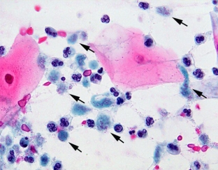 kak-pravilno-diagnostirovat-urogenitalnyj-trikhomoniaz
