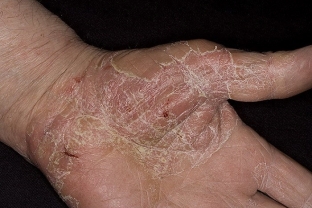 kak-proyavlyayutsya-allergicheskie-dermatozy-osobennosti-klinicheskoj-kartiny