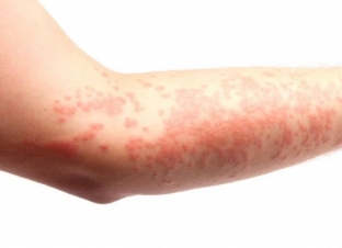 kak-proyavlyayutsya-allergicheskie-dermatozy-osobennosti-klinicheskoj-kartiny