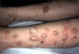 kak-proyavlyayutsya-allergicheskie-dermatozy-osobennosti-klinicheskoj-kartiny