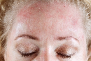 kak-proyavlyayutsya-allergicheskie-dermatozy-osobennosti-klinicheskoj-kartiny