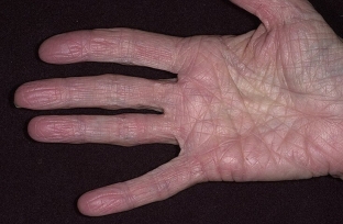 kak-proyavlyayutsya-allergicheskie-dermatozy-osobennosti-klinicheskoj-kartiny