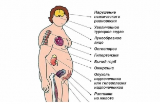 kak-raspoznat-sindrom-itsenko-kushinga-osnovnye-simptomy