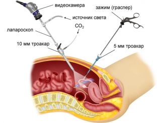 kak-sokhranit-reproduktivnuyu-funktsiyu-posle-lecheniya-vnematochnoj-beremennosti