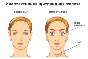 kak-sostoyanie-shchitovidnoj-zhelezy-otrazhaetsya-na-nashem-zdorove