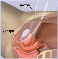 kak-spravitsya-s-nederzhaniem-mochi-zolotoj-standart-lecheniya