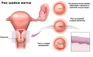 kak-stadiya-protsessa-vliyaet-na-lechenie-raka-shejki-matki