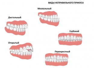 kak-ukhod-za-zubami-vliyaet-na-serdechnye-zabolevaniya