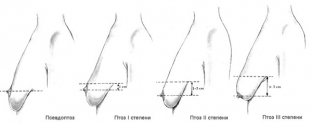 kak-vernut-krasivuyu-grud-posle-rodov