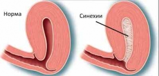 kakie-ginekologicheskie-manipulyatsii-mogut-vyzvat-amenoreyu