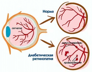 kakie-izmeneniya-glaznogo-dna-svidetelstvuyut-o-diabeticheskoj-retinopatii