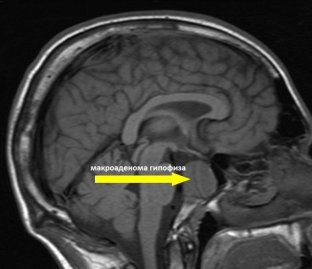 kakie-metody-pomogut-diagnostirovat-i-vylechit-giperprolaktinemiyu-u-zhenshchin