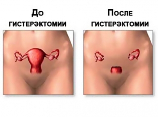 kakie-nepriyatnye-simptomy-mogut-bespokoit-zhenshchinu-posle-gisterektomii