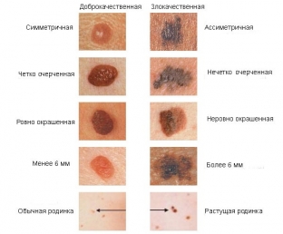kakie-obrazovaniya-na-kozhe-svidetelstvuyut-o-zlokachestvennoj-melanome