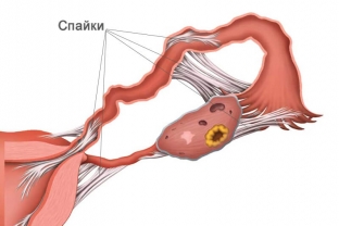 kakie-priznaki-ukazhut-na-razvitie-vnematochnoj-beremennosti