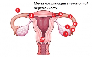 kakie-priznaki-ukazhut-na-razvitie-vnematochnoj-beremennosti