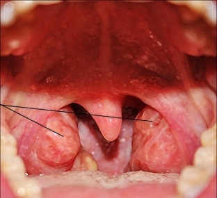 kakie-simptomy-adenoidov-u-rebenka-trebuyut-obrashcheniya-k-doktoru