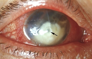 kakie-simptomy-avitaminoza-obnaruzhivayutsya-v-strukturakh-glaza