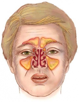 kakie-simptomy-sinusita-provotsiruet-barotravma