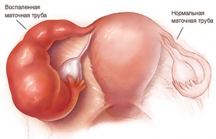 kakie-simptomy-ukazhut-na-razvitie-khronicheskogo-adneksita