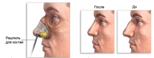 kakie-transplantaty-ispolzuyutsya-dlya-korrektsii-spinki-nosa-pri-rinoplastike