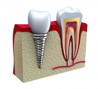 kakim-dolzhen-byt-ukhod-za-polostyu-rta-do-i-posle-implantatsii-zubov