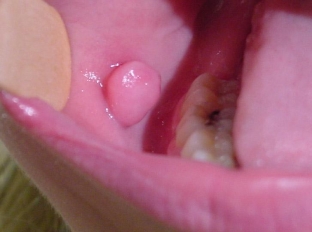 kakuyu-opasnost-neset-fibroma-polosti-rta