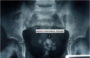kamni-v-mochevom-puzyre-kak-raspoznat-i-vylechit-zabolevanie