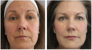 karboksiterapiya-carboxy-co2-dlya-litsa-i-shei-neinvazivnoe-reshenie-esteticheskikh-problem