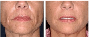 karboksiterapiya-carboxy-co2-dlya-litsa-i-shei-neinvazivnoe-reshenie-esteticheskikh-problem