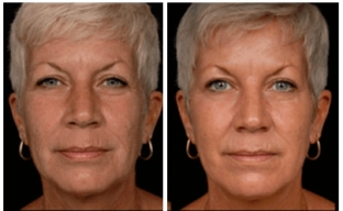 karboksiterapiya-carboxy-co2-dlya-litsa-i-shei-neinvazivnoe-reshenie-esteticheskikh-problem