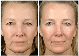 karboksiterapiya-carboxy-co2-dlya-litsa-i-shei-neinvazivnoe-reshenie-esteticheskikh-problem