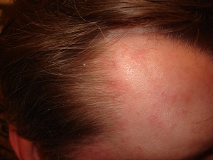 khronicheskie-dermatozy-kozhi-golovy-kak-razlichat-i-chem-lechit