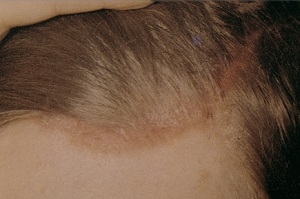 khronicheskie-dermatozy-kozhi-golovy-kak-razlichat-i-chem-lechit